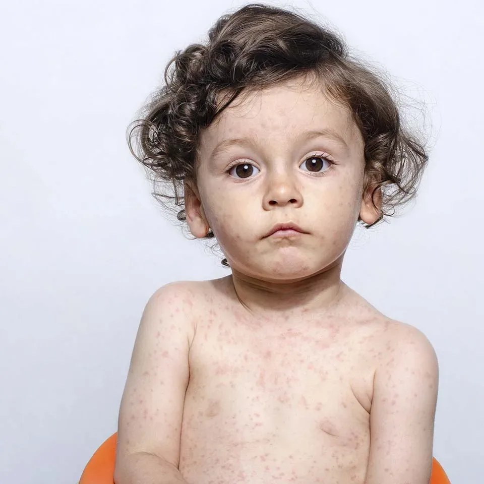 Alimentos que más causan alergias en los bebés